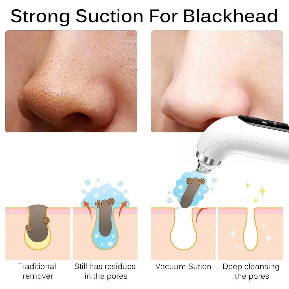 Blackhead Remover Pore Vacuum